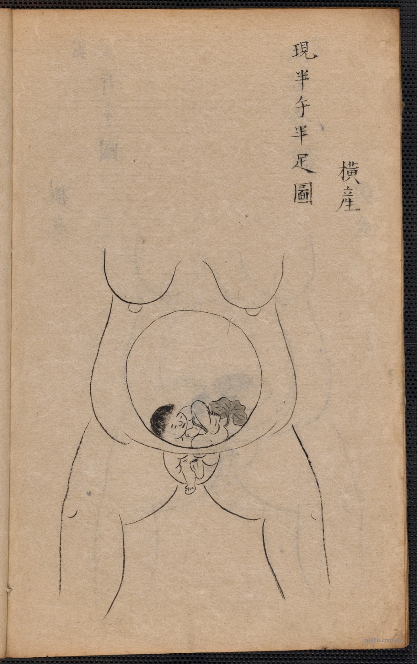 中医产科古籍《蛭田流产科》